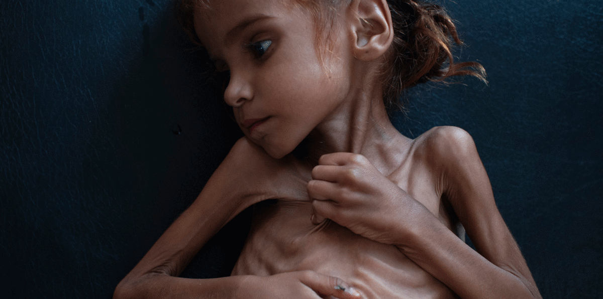 ماتت الصغيرة "أمل حسين".. رمز معاناة اليمنيين من سلطة الحوثيين