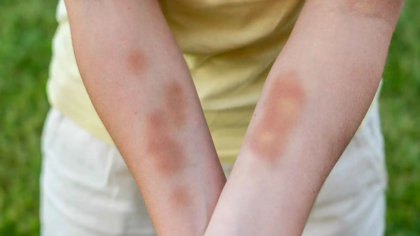 الكدمات العشوائية على الجسم.. متى تستدعي القلق؟