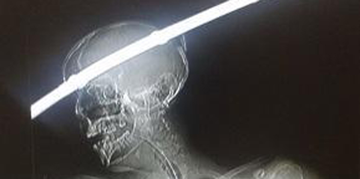 شاب ينجو بأعجوبة بعد اختراق قضيب معدني رأسه (صور)