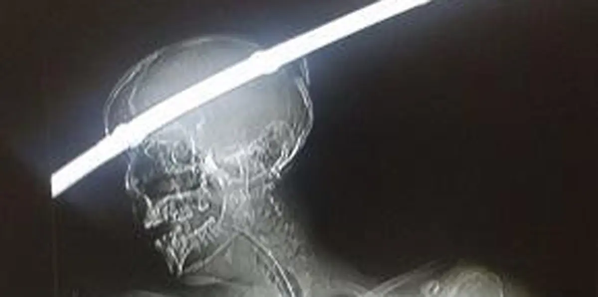 شاب ينجو بأعجوبة بعد اختراق قضيب معدني رأسه (صور)