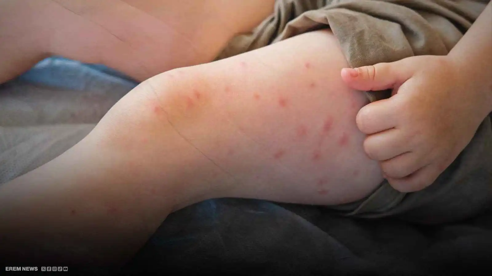 "خذوا اللقاح".. ارتفاع مخيف لحالات الحصبة يثير القلق في أمريكا (فيديو إرم)