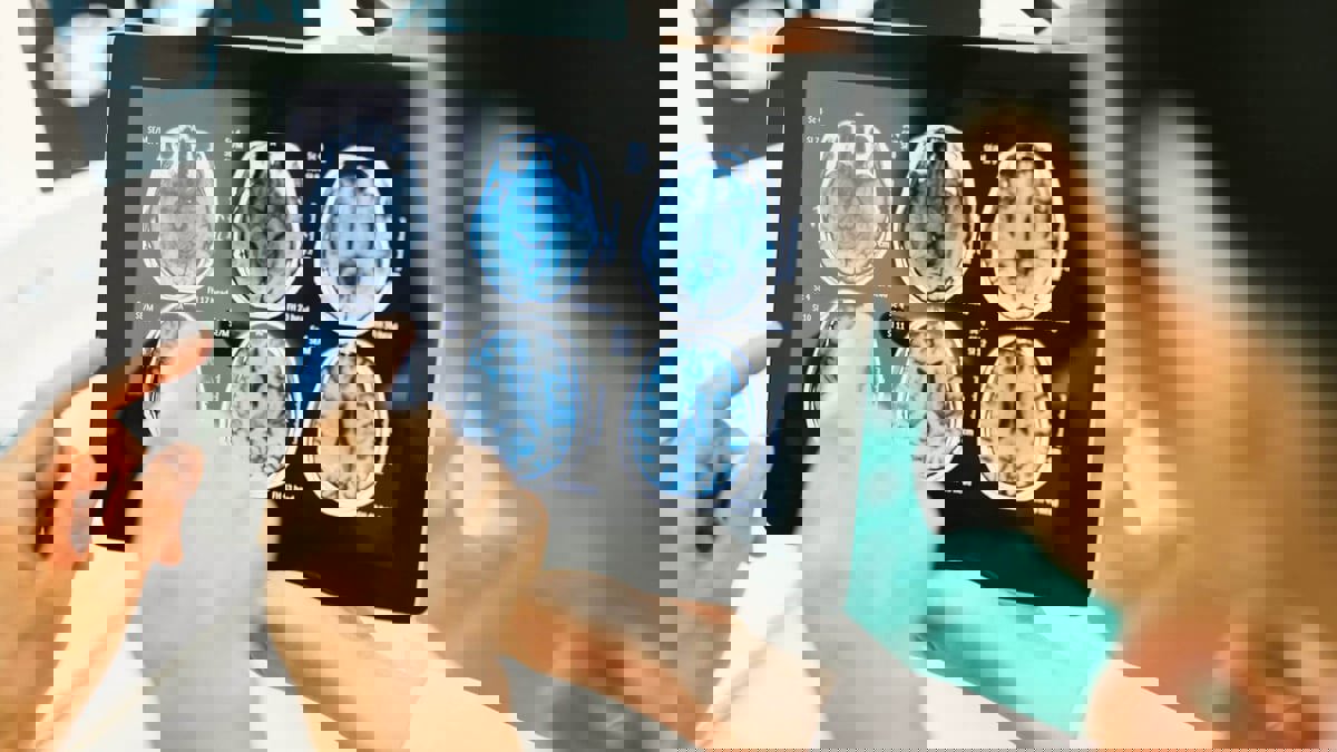 تطوير طريقة لاختراق الحاجز الدماغي الدموي.. ما تأثير ذلك على مرضى الزهايمر؟