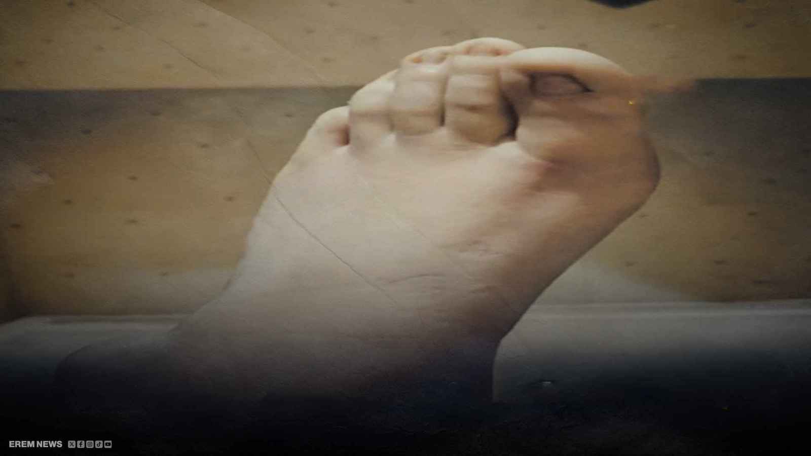 بترت ساقها واحتفظت بها بالثلاجة.. ممرضة تُشعل الجدل