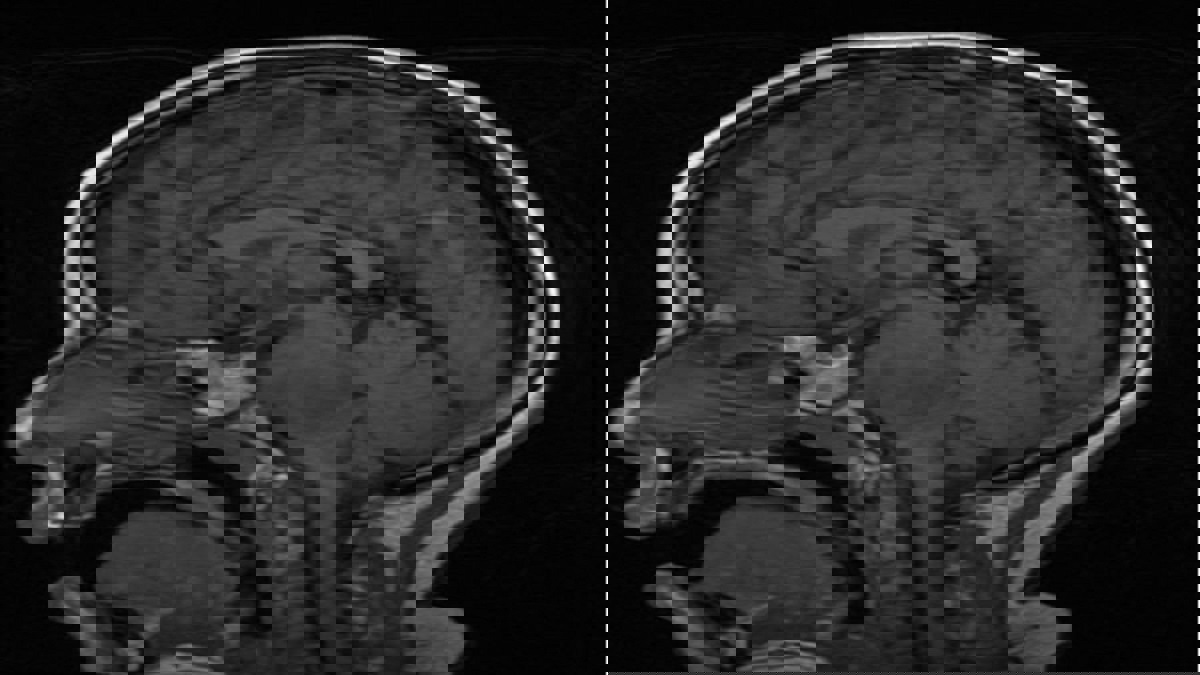 اكتشاف علاج للأطفال المصابين بسرطان الدماغ غير القابل للشفاء