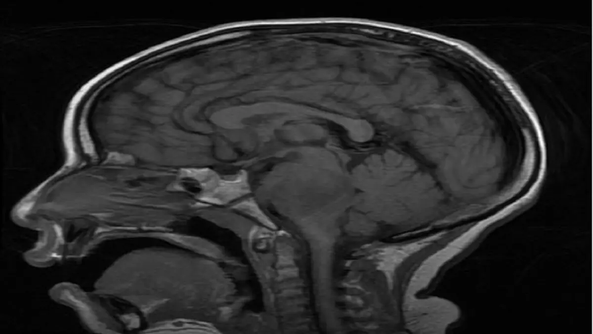 اكتشاف علاج للأطفال المصابين بسرطان الدماغ غير القابل للشفاء