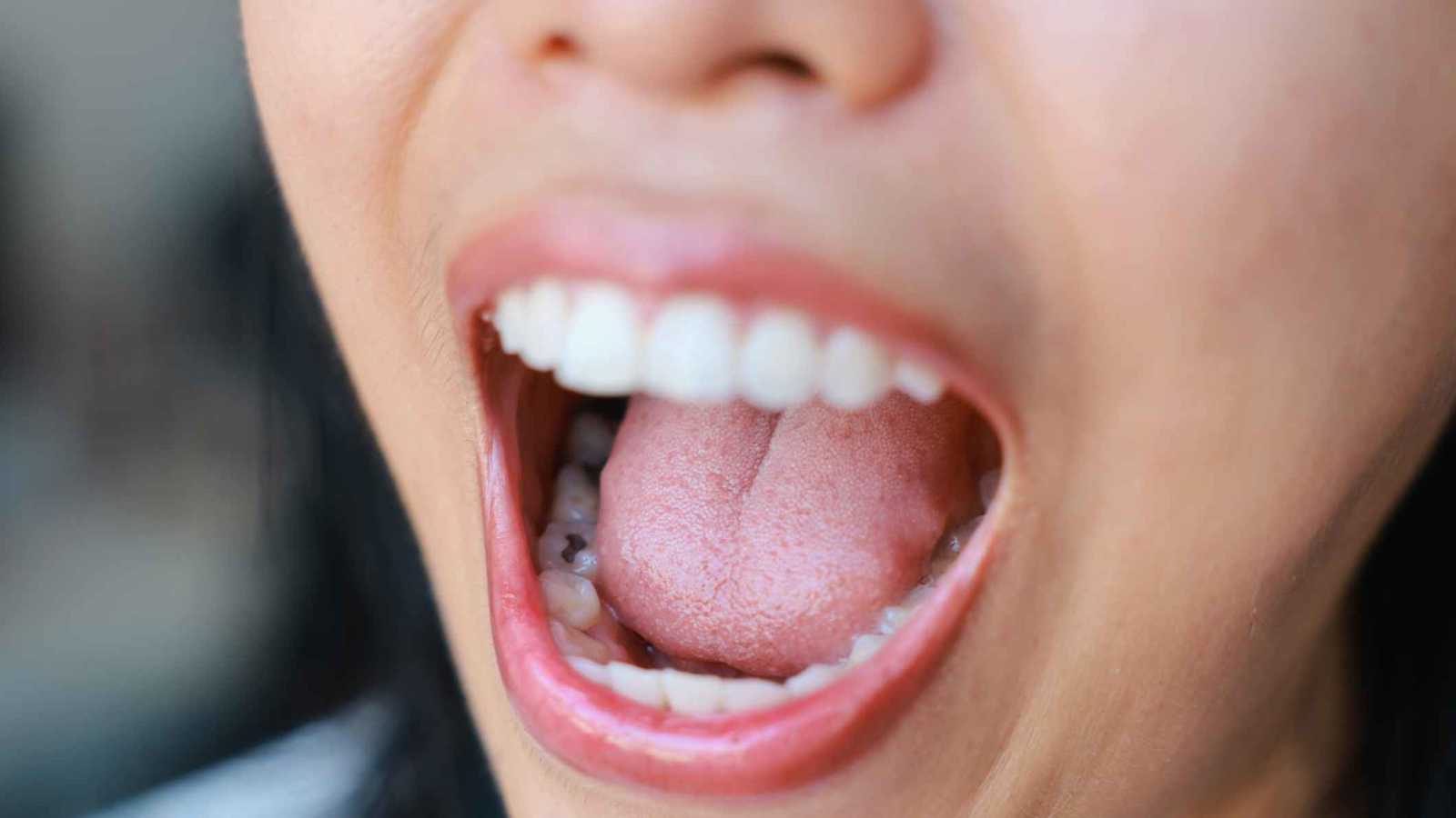 بكتيريا الفم تسهم في تصلب الشرايين والنوبات القلبية