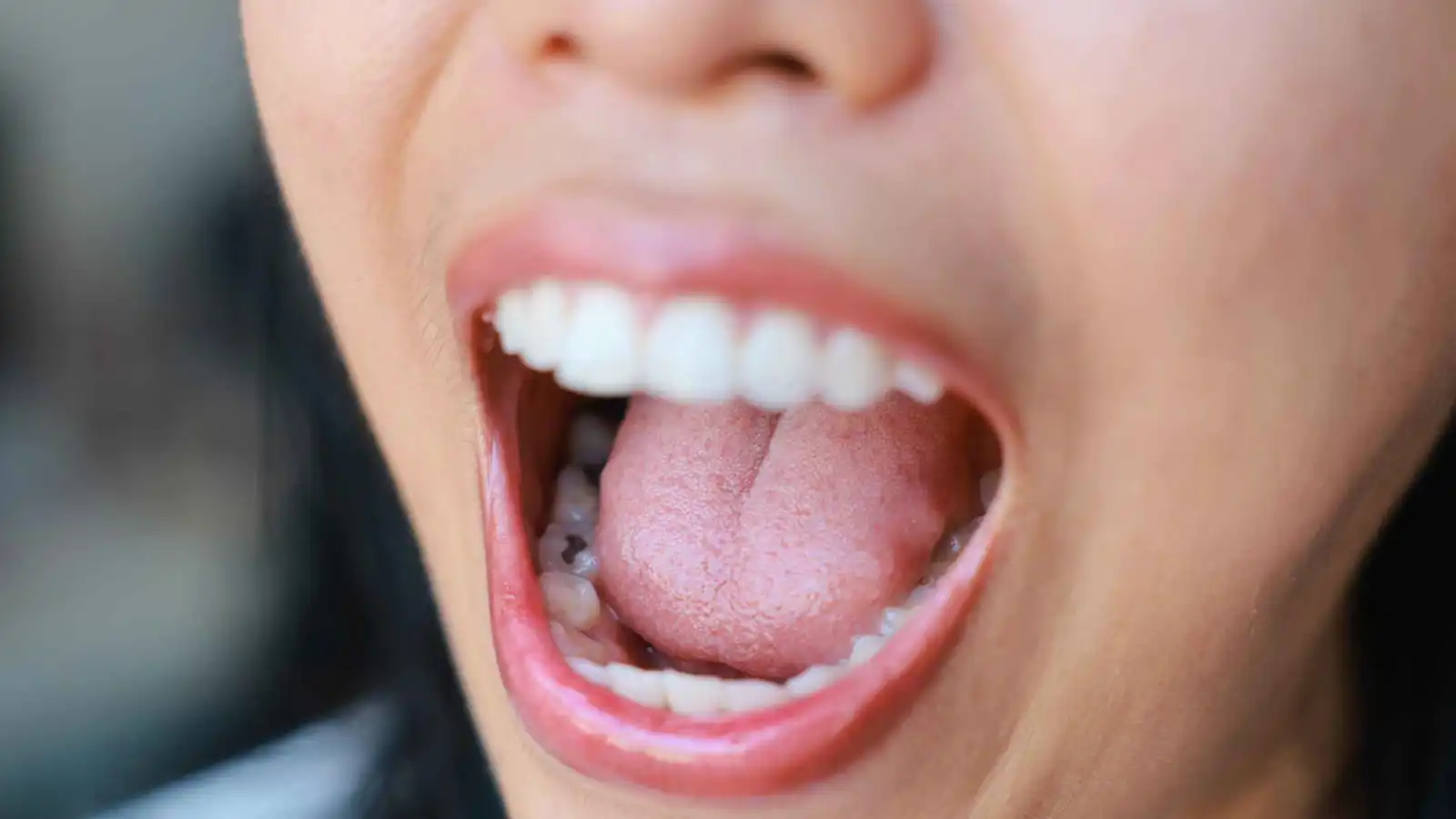 بكتيريا الفم تسهم في تصلب الشرايين والنوبات القلبية