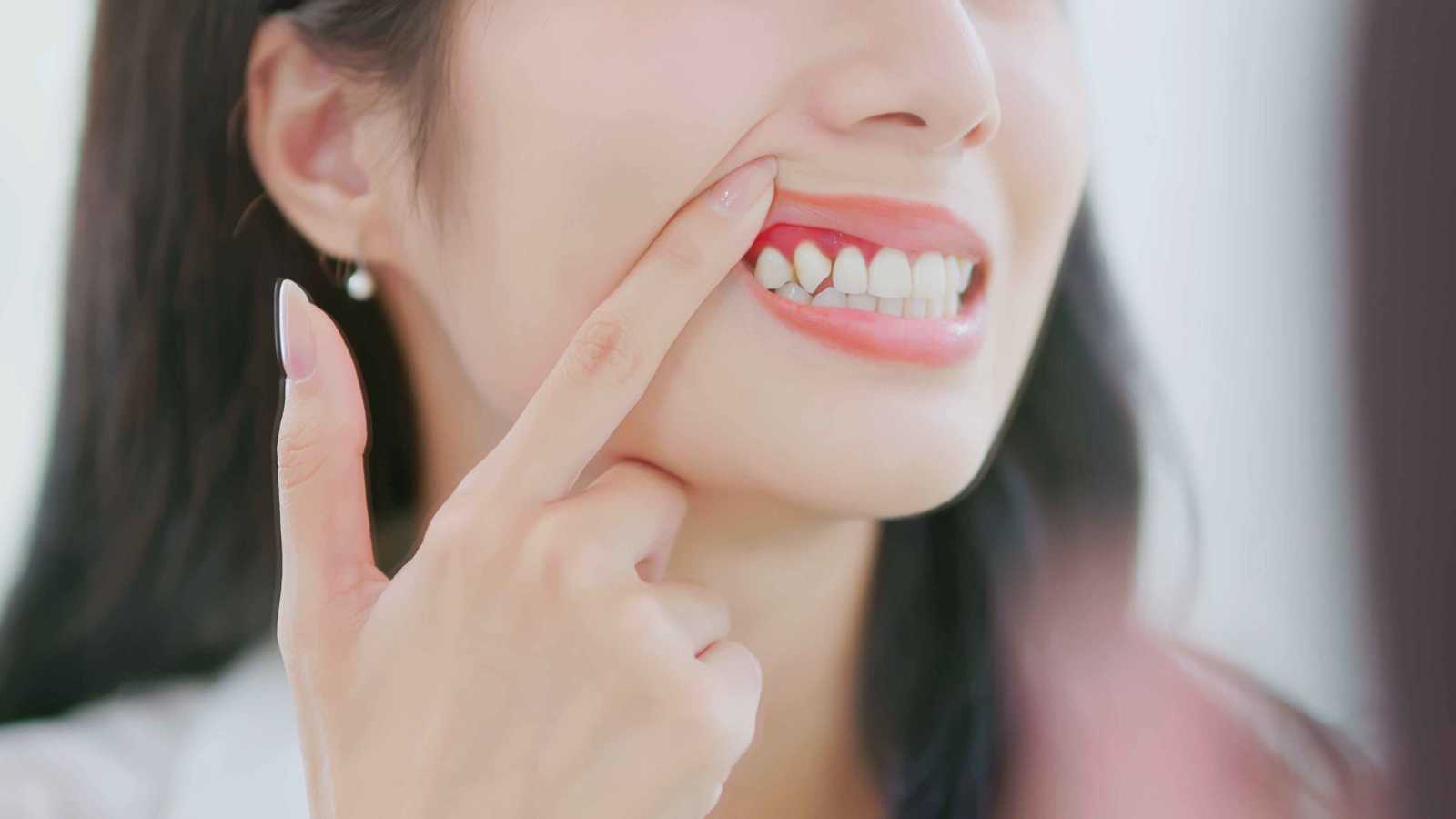 أمراض اللثة تزيد خطر تلف المادة البيضاء في الدماغ