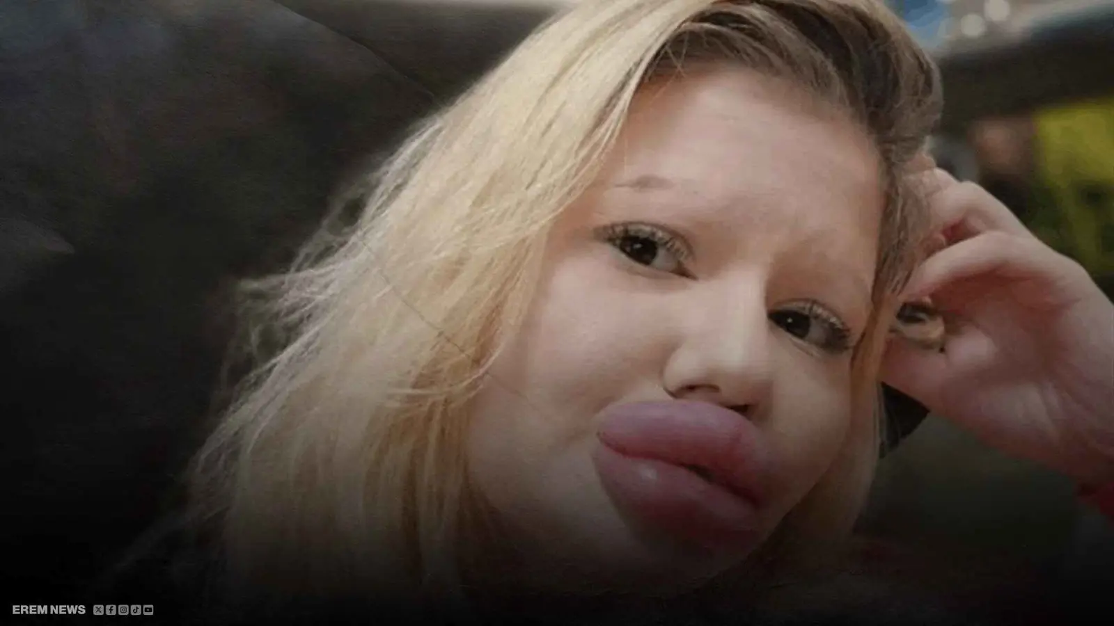 صاحبة أكبر شفاه تتوسل النجدة والأطباء يرفضون