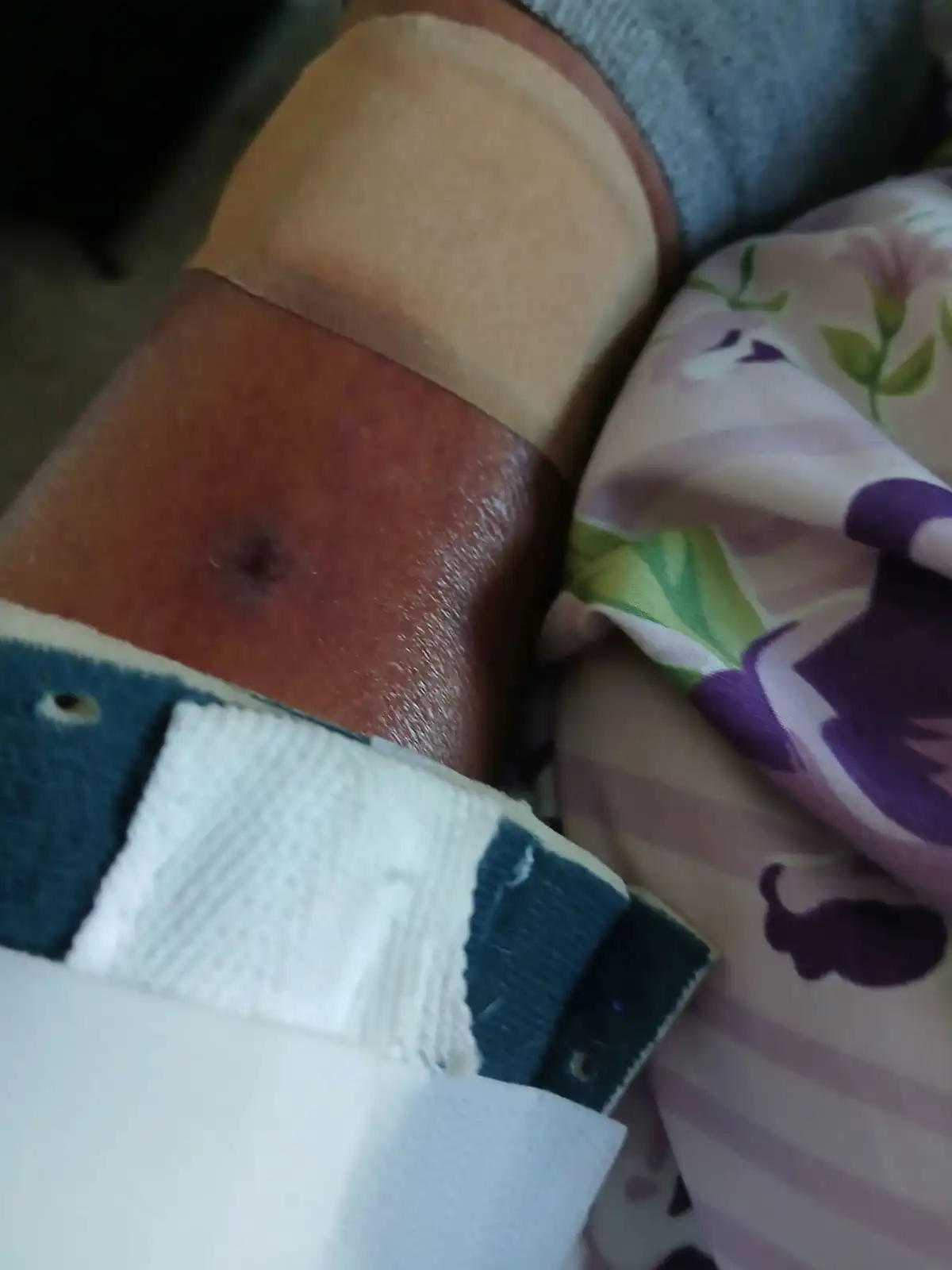 باتريشا اثناء تلقيها العلاج