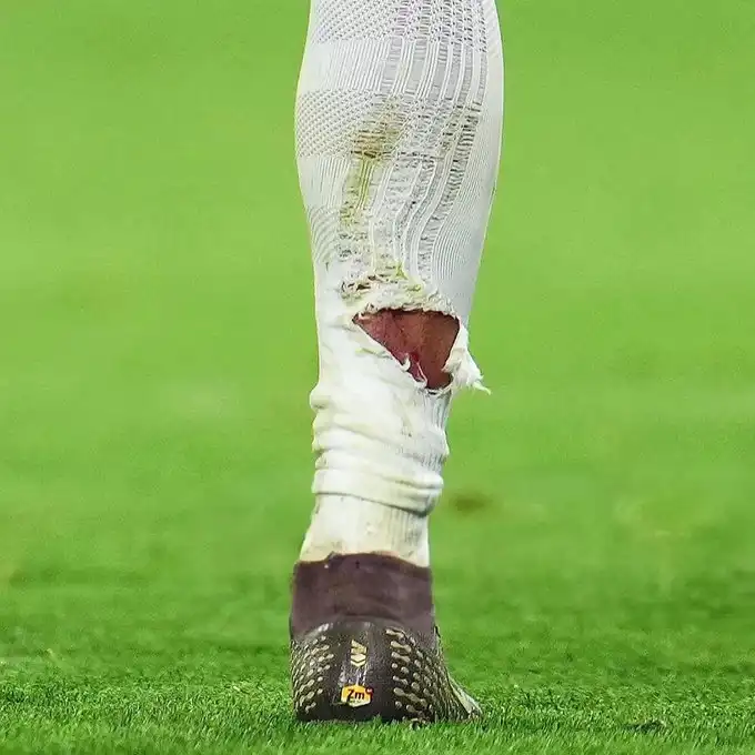 جوارب مبابي الممزقة بعد تدخل جوناثان تاه