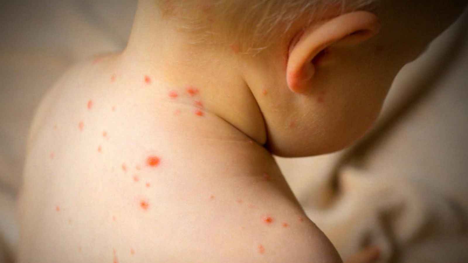 طنجة المغربية تستنفر بعد تسجيل إصابات بحصبة "بوحمرون"