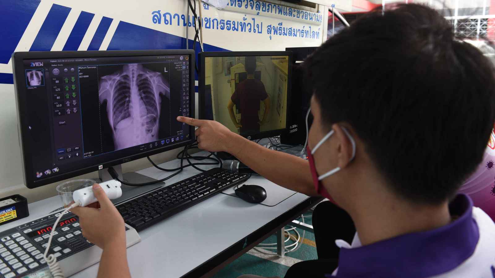 تقصر فترة التعافي.. علماء يبتكرون طريقة لعلاج كسور الأضلاع