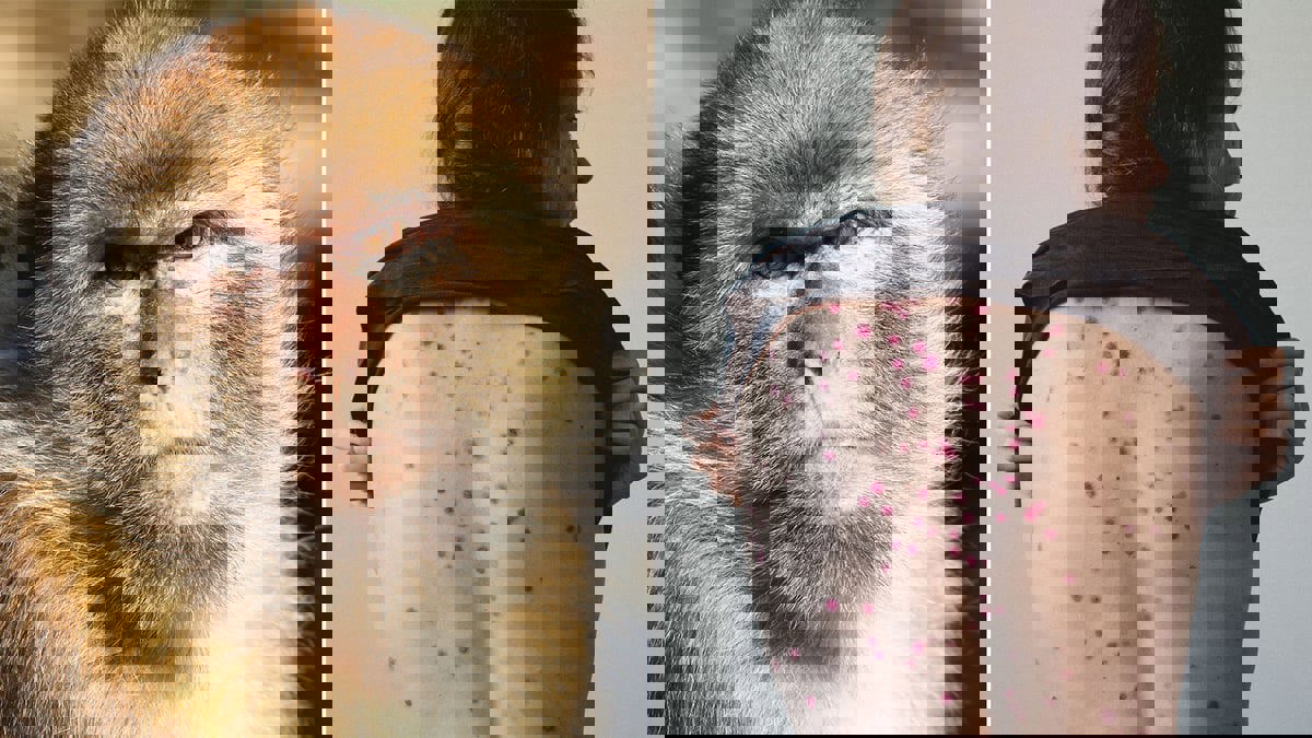 اجتماع طارئ لمنظمة الصحة بعد تجاوز إصابات جدري القرود المئة في أوروبا