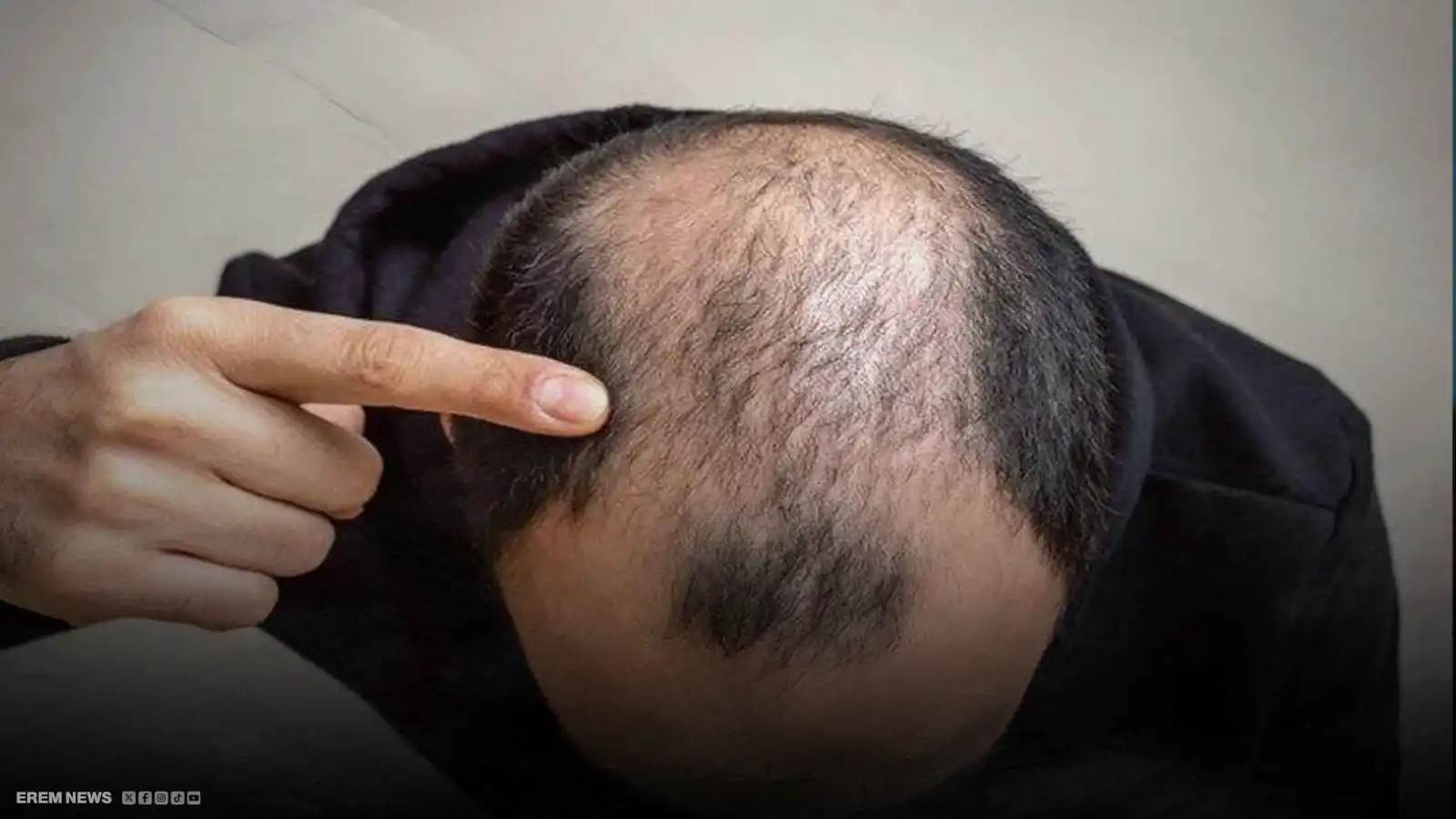 قبعة ذكية تعيد الحياة لبصيلات الشعر.. هل نقول وداعا للصلع؟