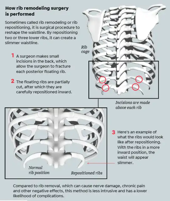 جراحة "إعادة تشكيل الأضلاع"