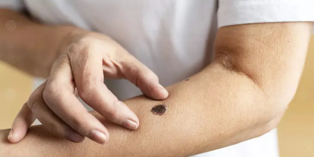 تشخيص سرطان الجلد أصبح أسهل بفضل الذكاء الاصطناعي