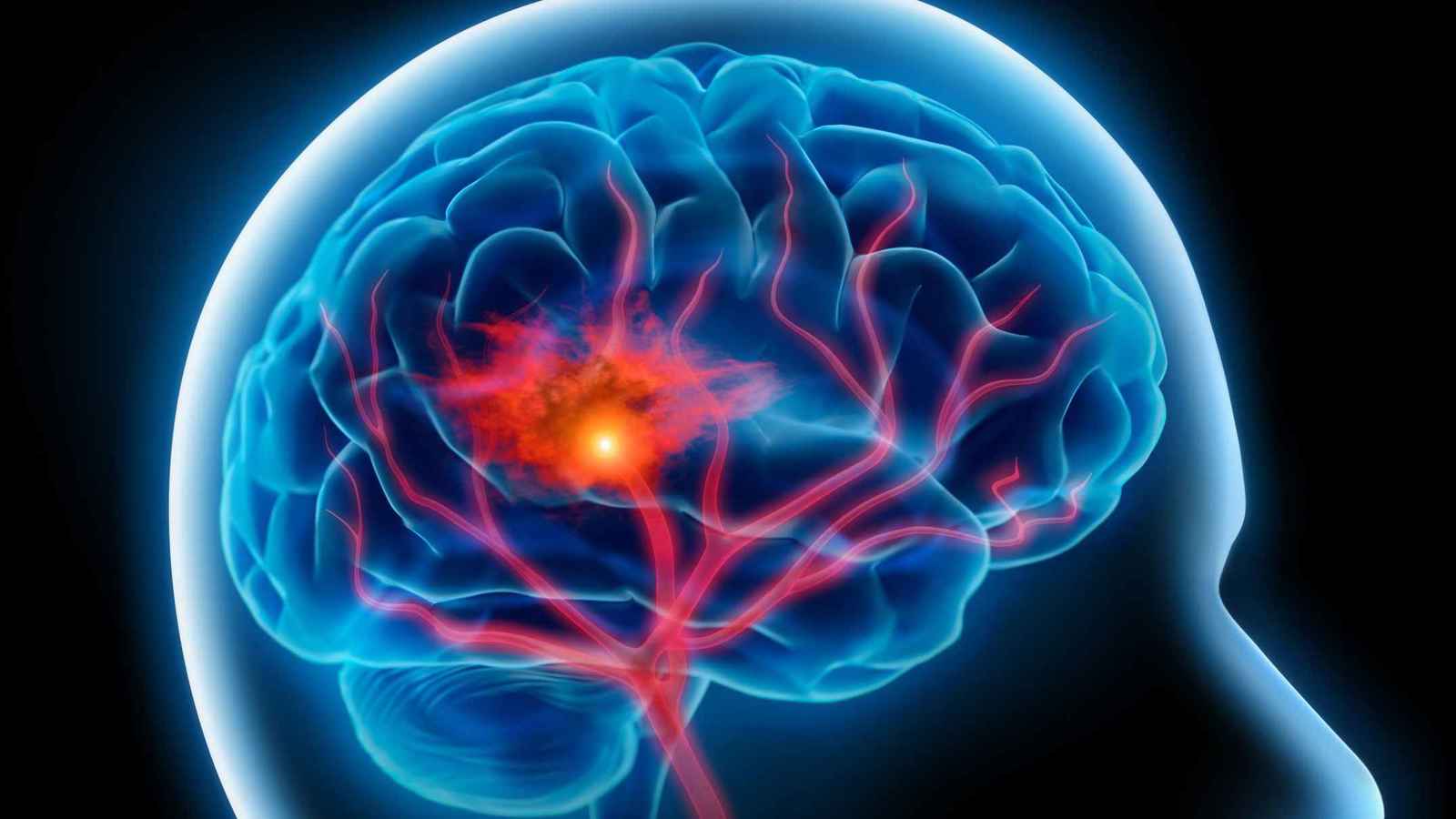 "علاقة غامضة" بين البلاستيك والسكتات الدماغية