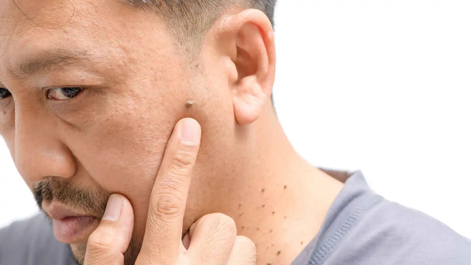 الزوائد الجلدية.. إشارة تحذيرية مبكرة لمقاومة الأنسولين