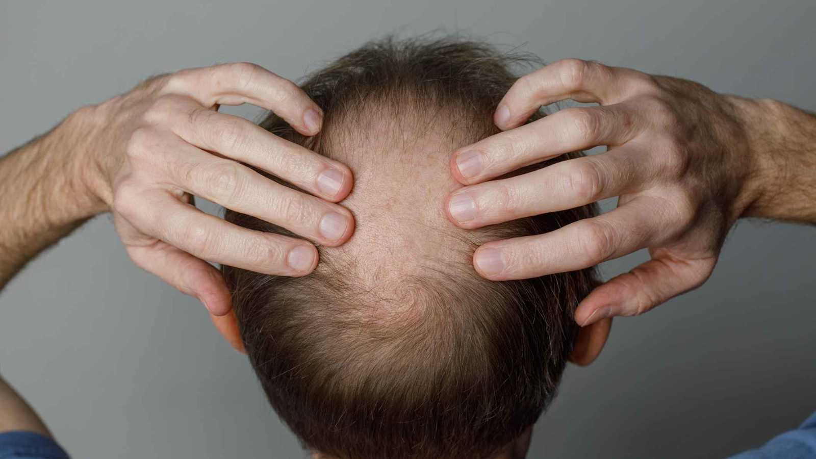 دواء مبتكر يعيد نمو الشعر بكثافة في غضون أسابيع