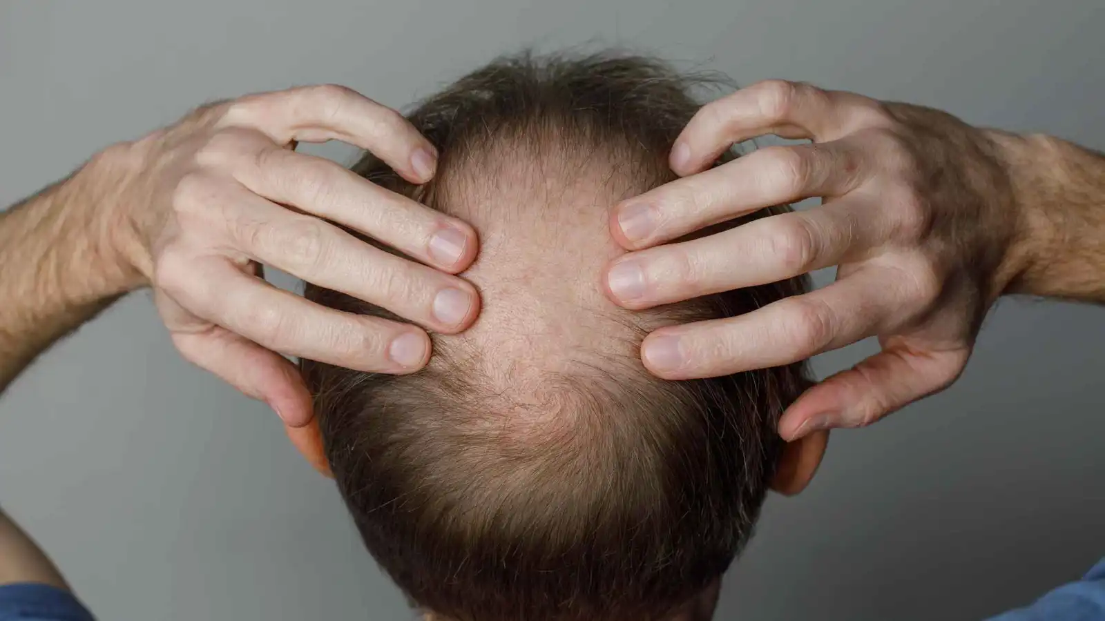 دواء مبتكر يعيد نمو الشعر بكثافة في غضون أسابيع