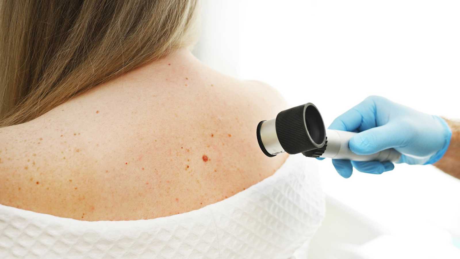 3 علامات تحذيرية تدل على سرطان الجلد.. لا تهملها