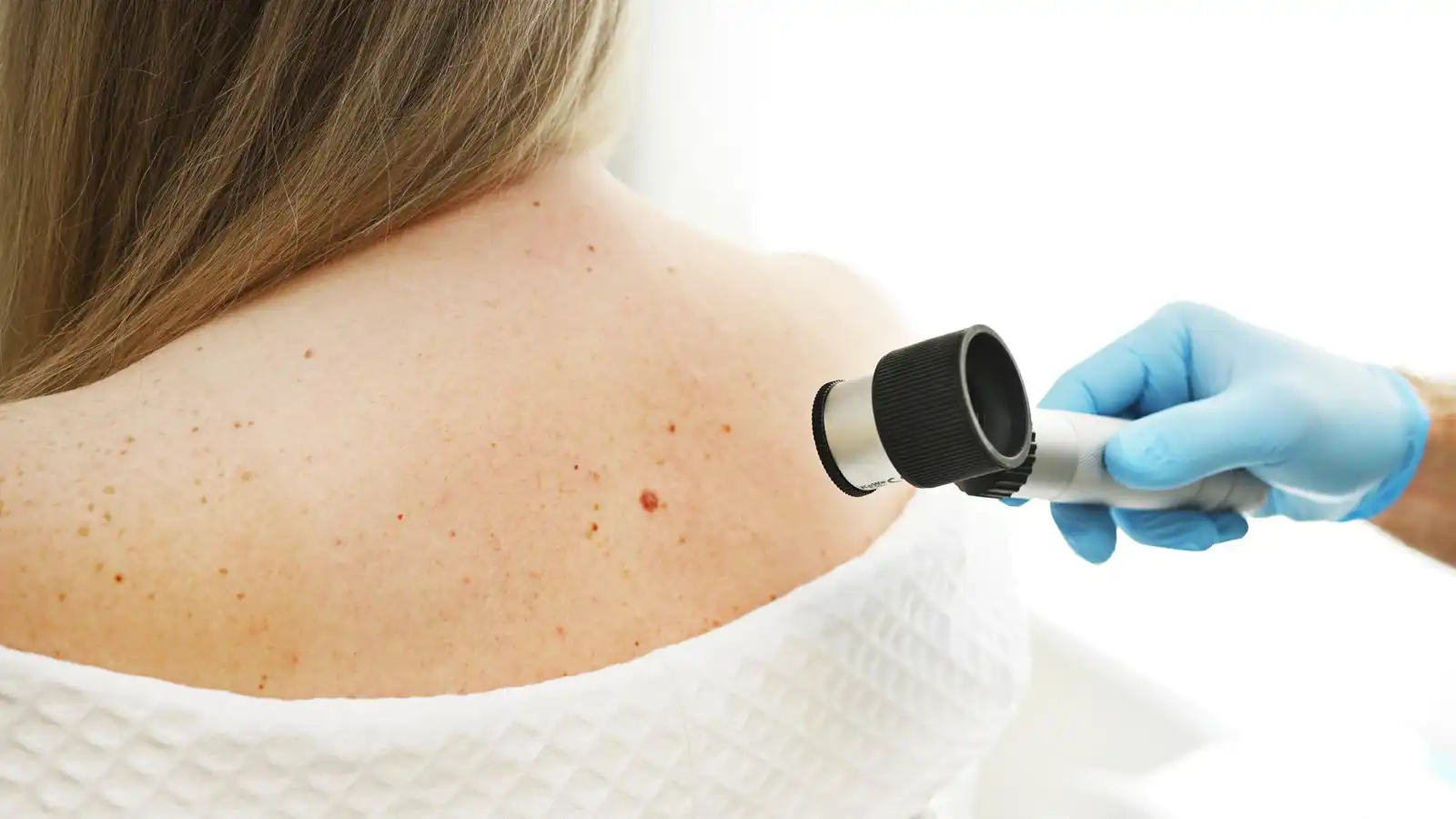 3 علامات تحذيرية تدل على سرطان الجلد.. لا تهملها