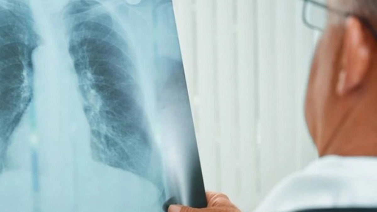 5 أطعمة تساعدك على التعافي من الالتهاب الرئوي