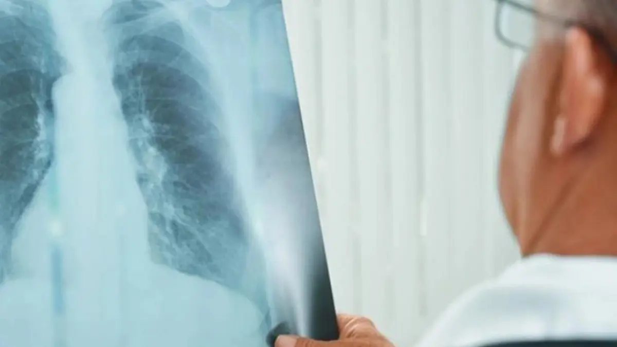 5 أطعمة تساعدك على التعافي من الالتهاب الرئوي