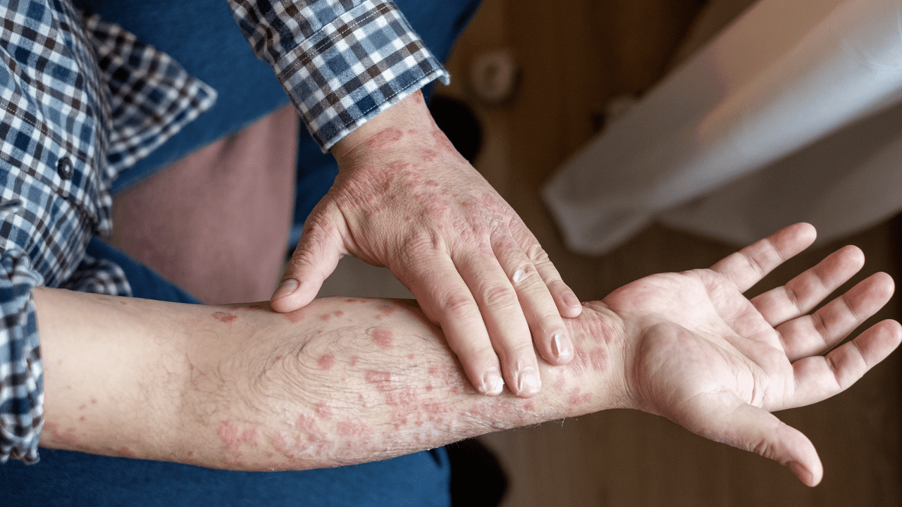 "دوبيكسينت".. موافقة أمريكية تجدد أمل مئات الآلاف من مرضى الجلد