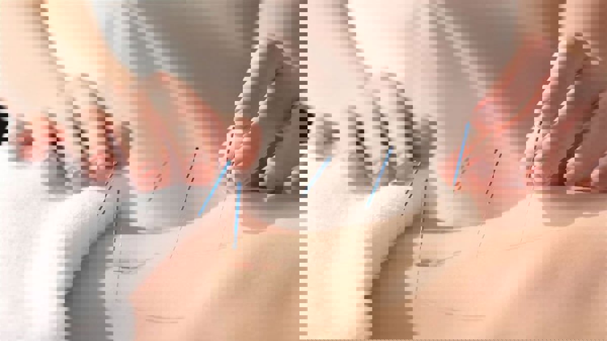 دراسة: الوخز بالإبر يمكن أن يساعد في تعزيز الرغبة الجنسية‎‎