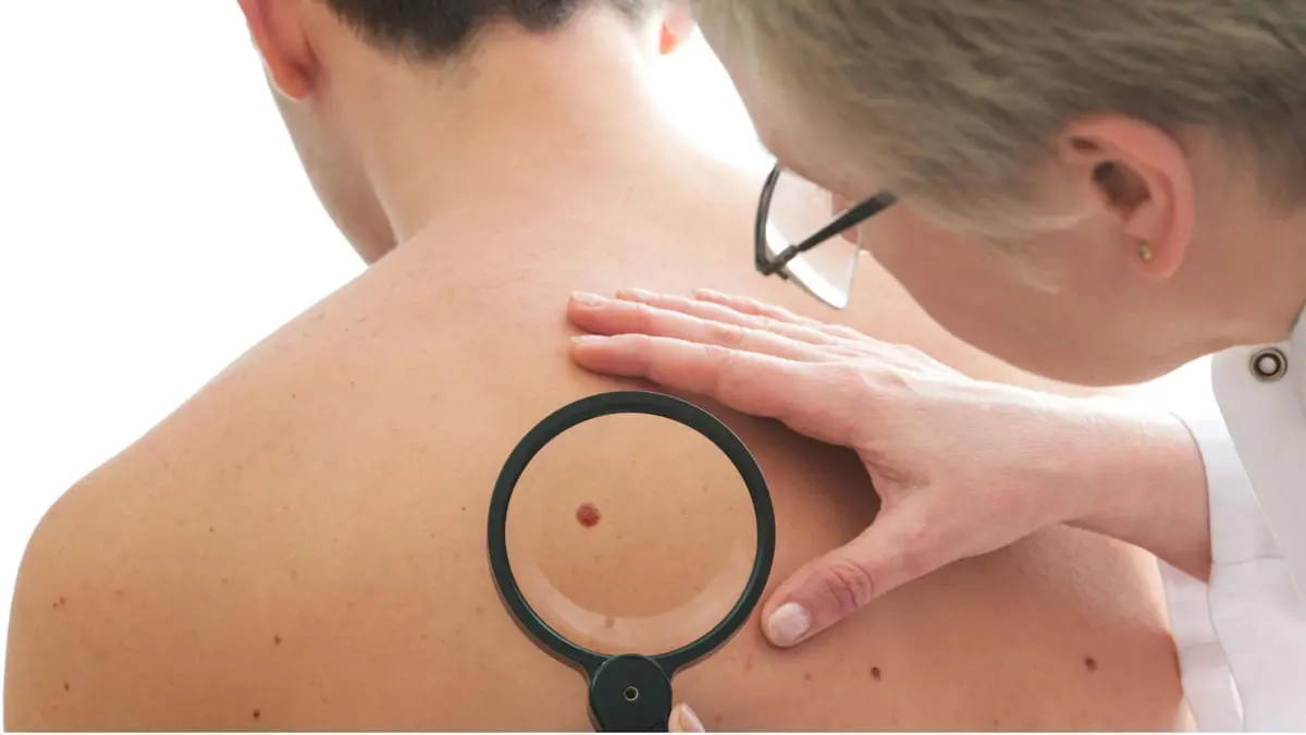 عدد الشامات مؤشر لخطر سرطان الجلد