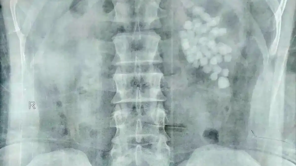 صورة حصى الكلى داخل جسم المريض