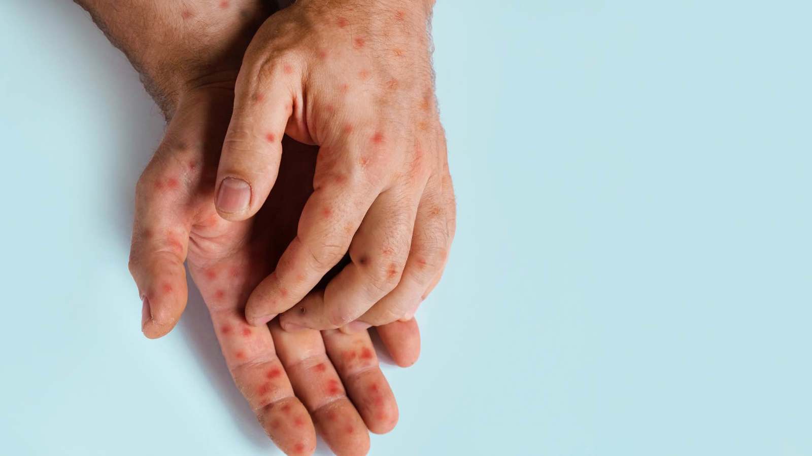 بريطانيا.. اكتشاف أول إصابة بفيروس جدري القردة