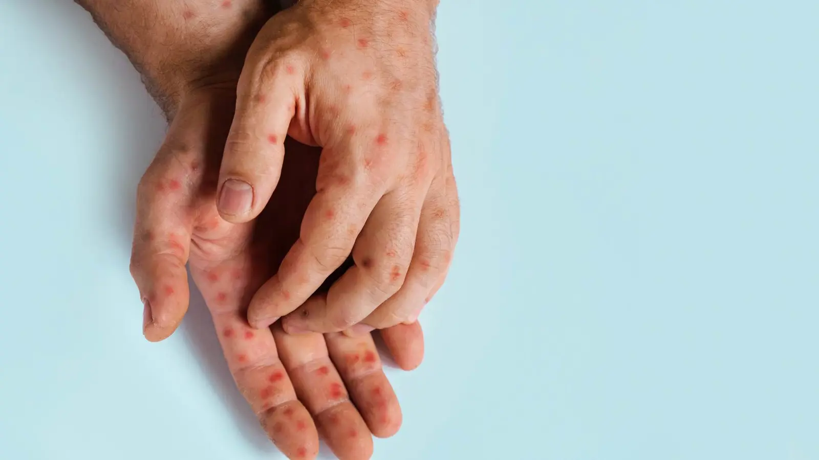 بريطانيا.. اكتشاف أول إصابة بفيروس جدري القردة