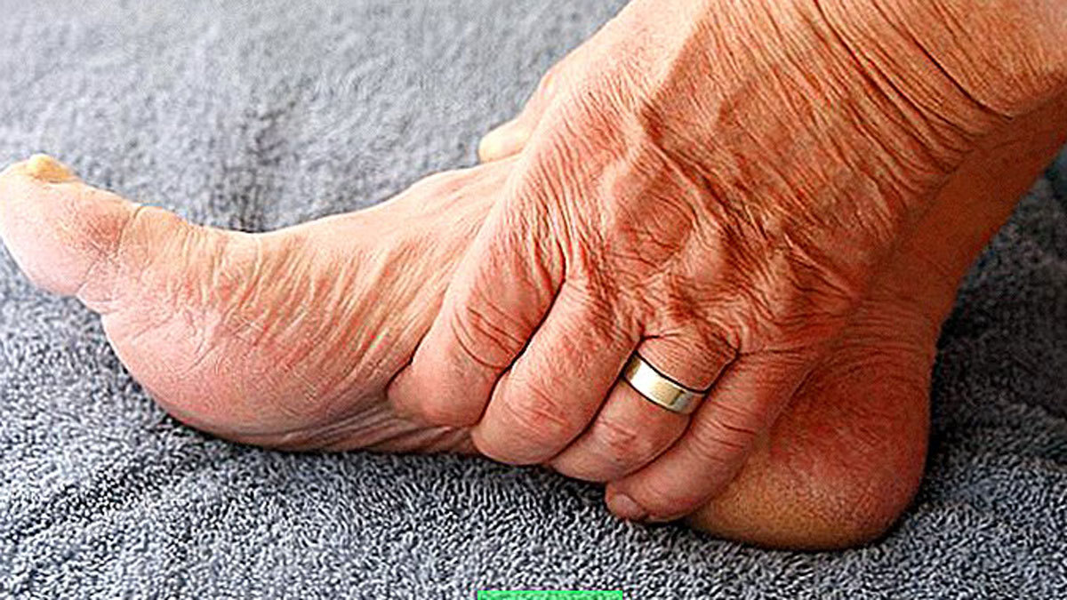 طرق بسيطة للتعامل مع مرض "وذمة السكري‎"