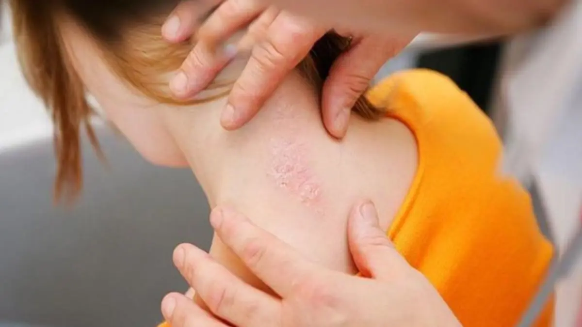 3 علاجات جديدة واعدة لمرض الصدفية