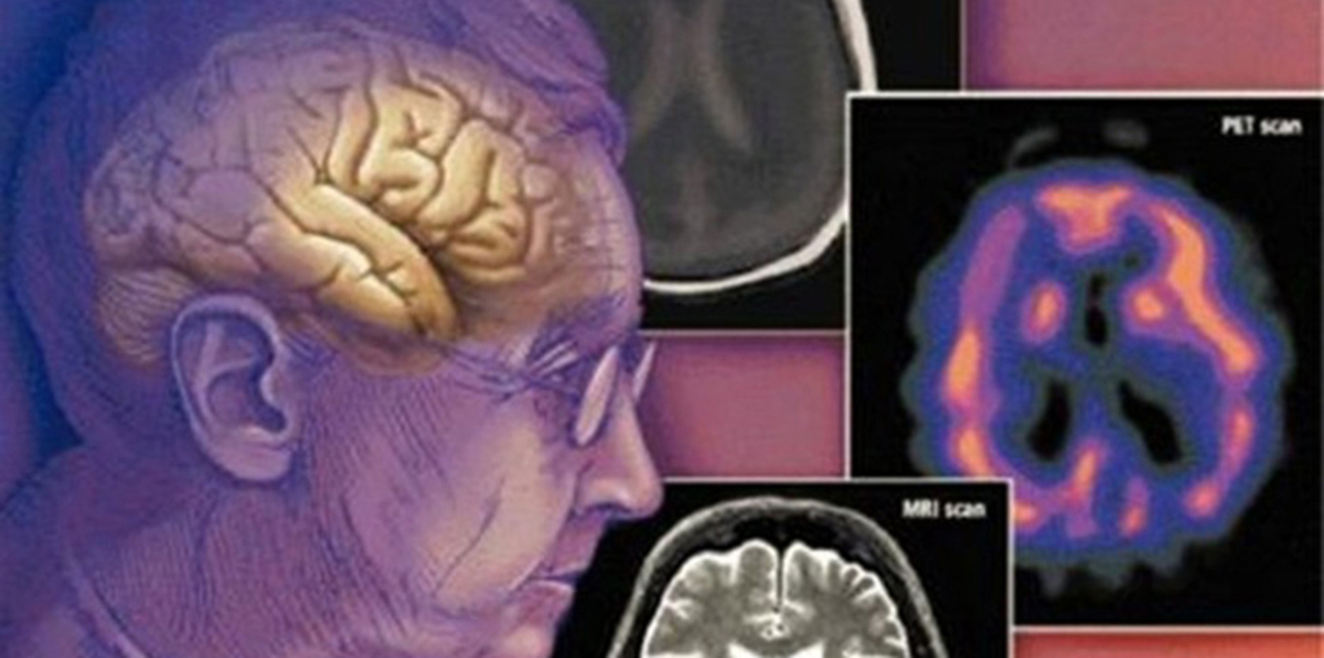 دراسة: الحشيش قد يساعد على تحسين الذاكرة وإبطاء شيخوخة الدماغ