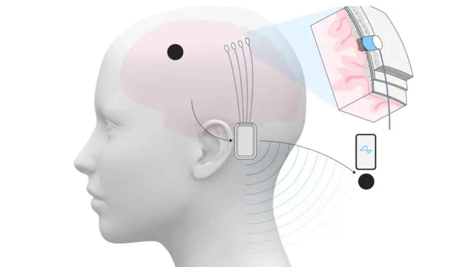 زراعة الشرائح الدماغية.. ماذا يخطط ماسك للبشرية في 2025؟