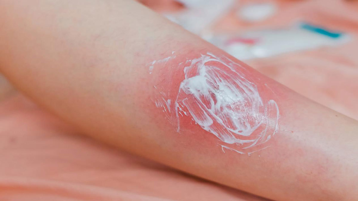 5 أطعمة تحارب الالتهابات الجلدية في فصل الشتاء.. تعرف عليها