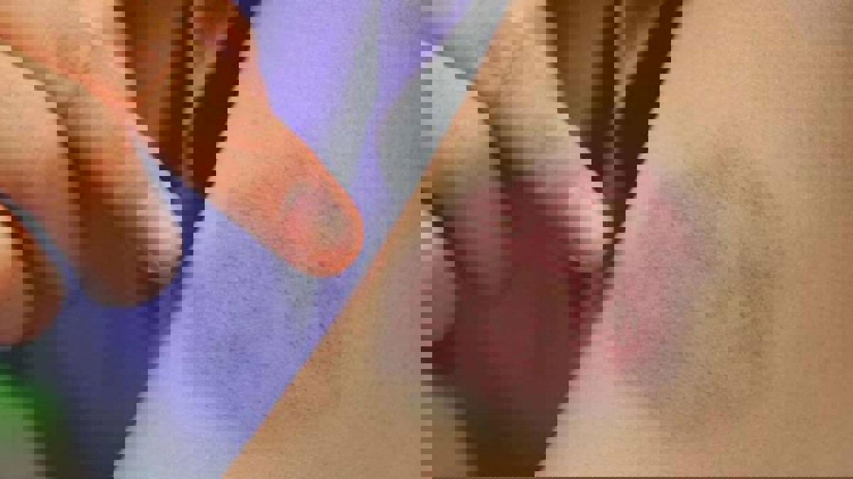 دراسة بريطانية حديثة تحدد الأعراض التي تسبق "جلطة الدم"