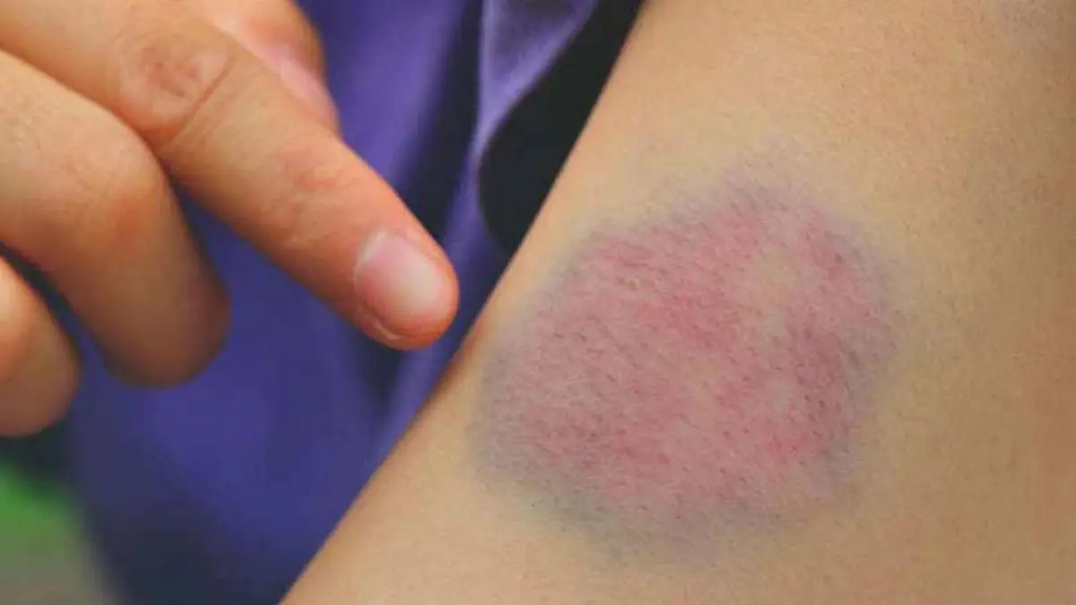 دراسة بريطانية حديثة تحدد الأعراض التي تسبق "جلطة الدم"