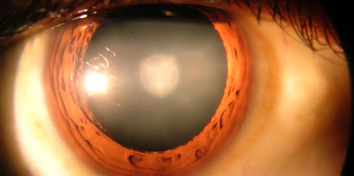 تعرف على أسباب مرض المياه البيضاء