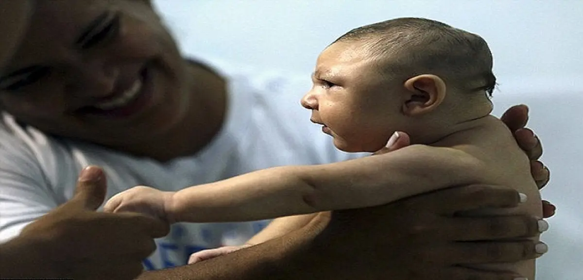 إسبانيا.. أول حالة تلف دماغي ناتج عن فيروس زيكا