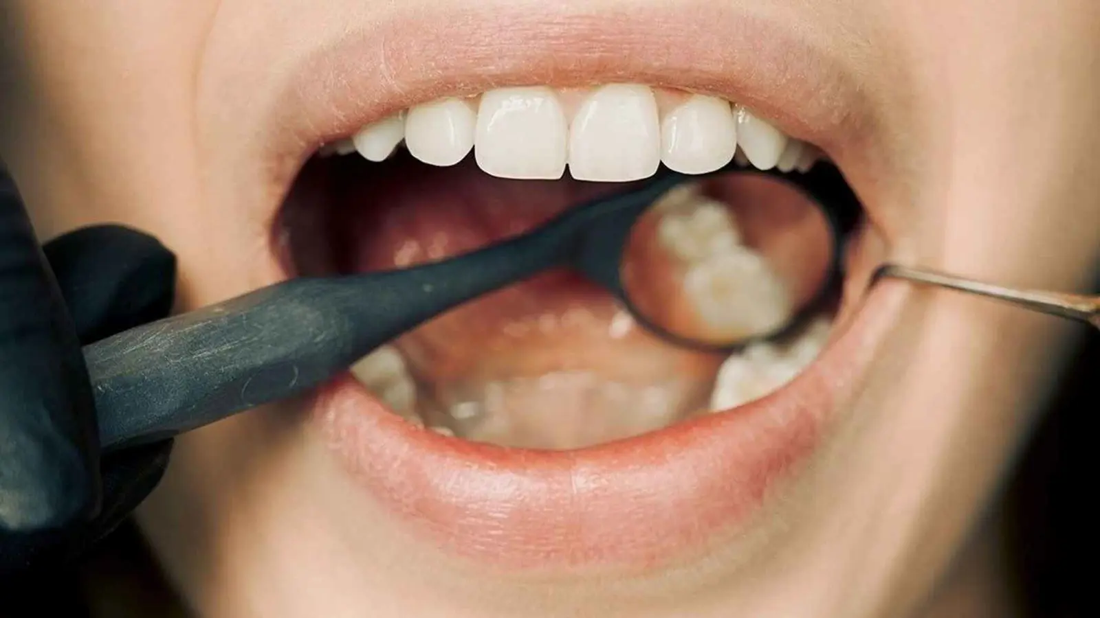 دراسة: بكتيريا الفم تحمي من التدهور الإدراكي للدماغ