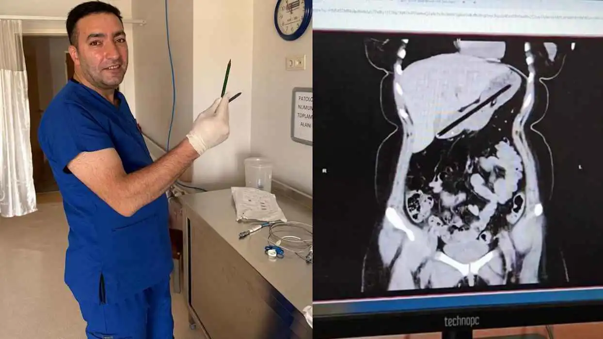 شابة تركية تبتلع قلمين بسبب الوسواس القهري (صور)