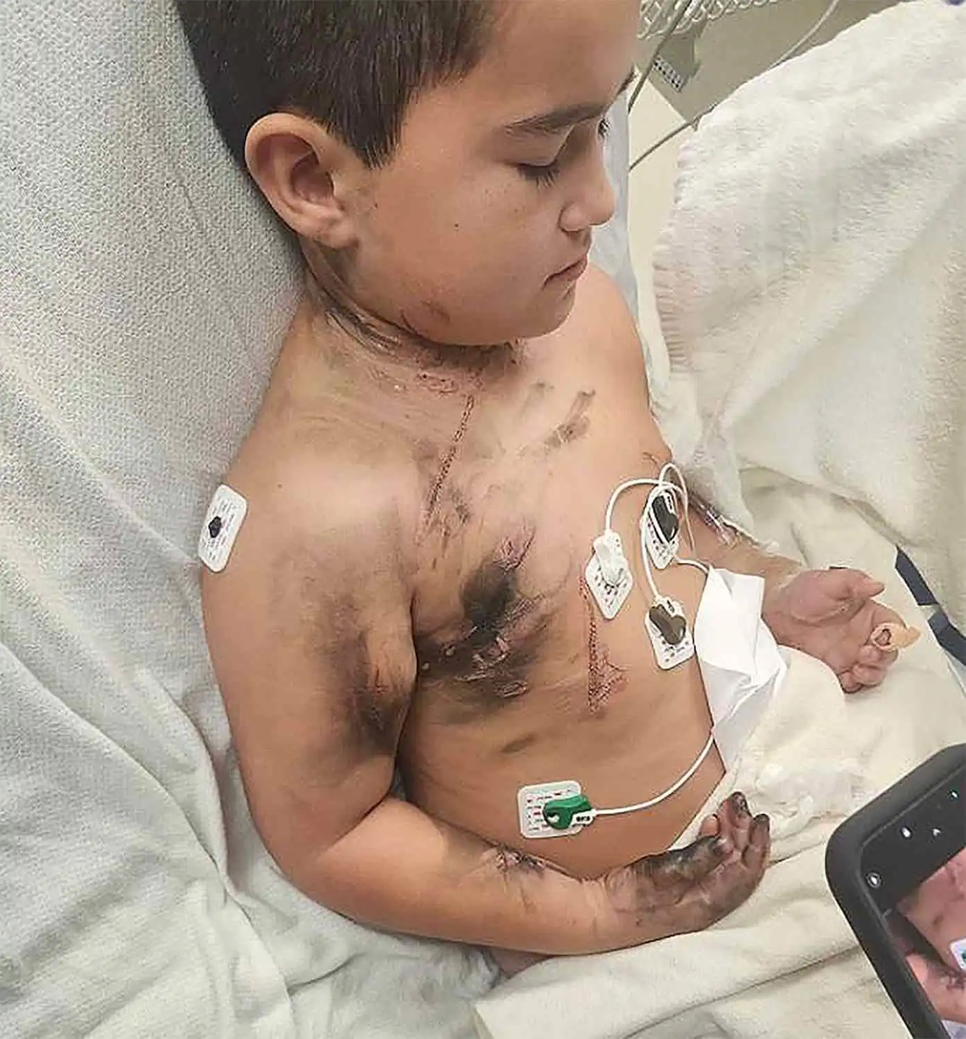 الطفل لورينزو لوبيز في المستشفى