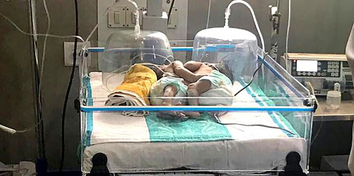 ولادة توأم ملتصق بقلب وكبد واحد في الهند (صور)