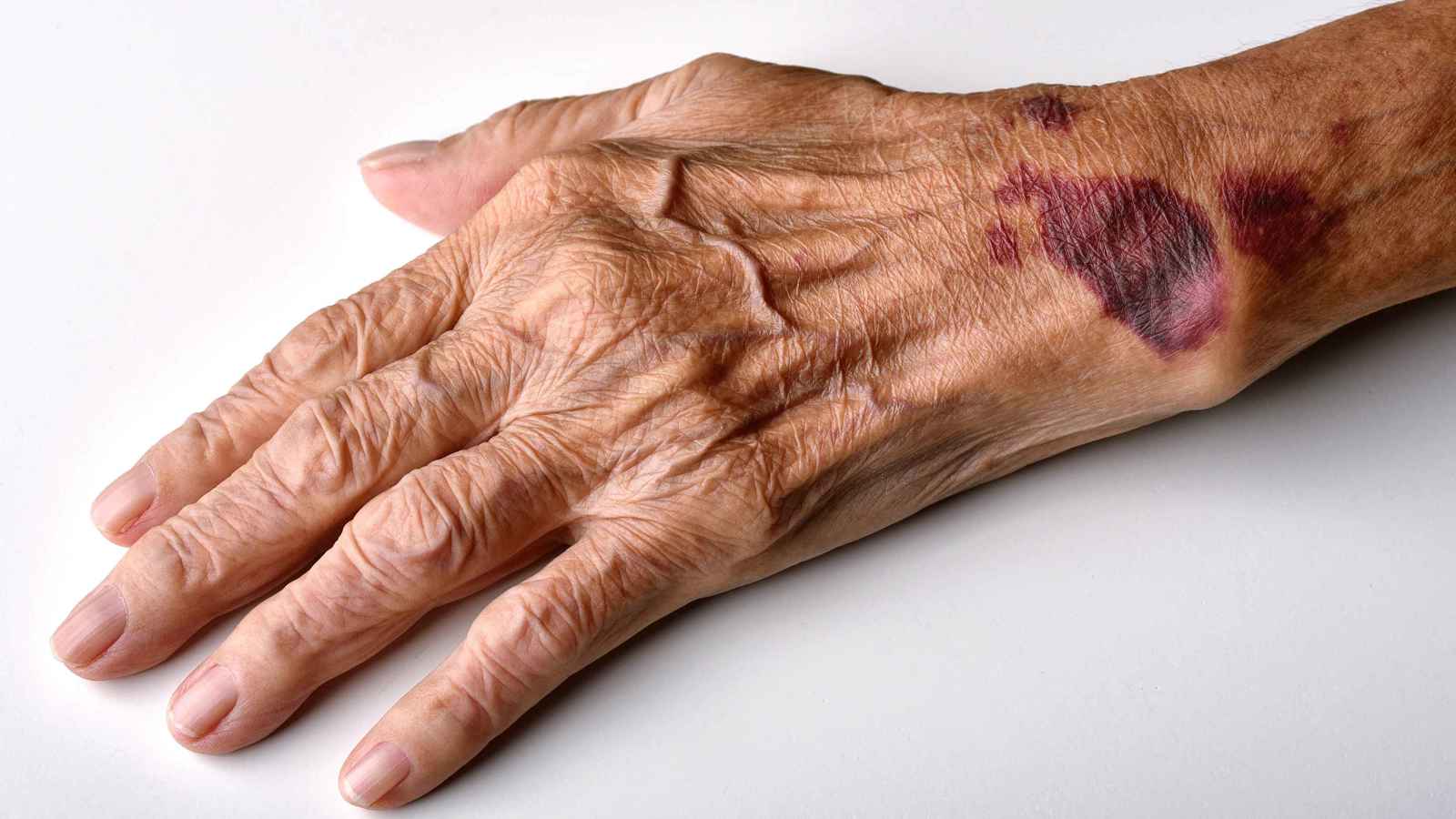 أسباب ظهور الكدمات على أجسام كبار السن