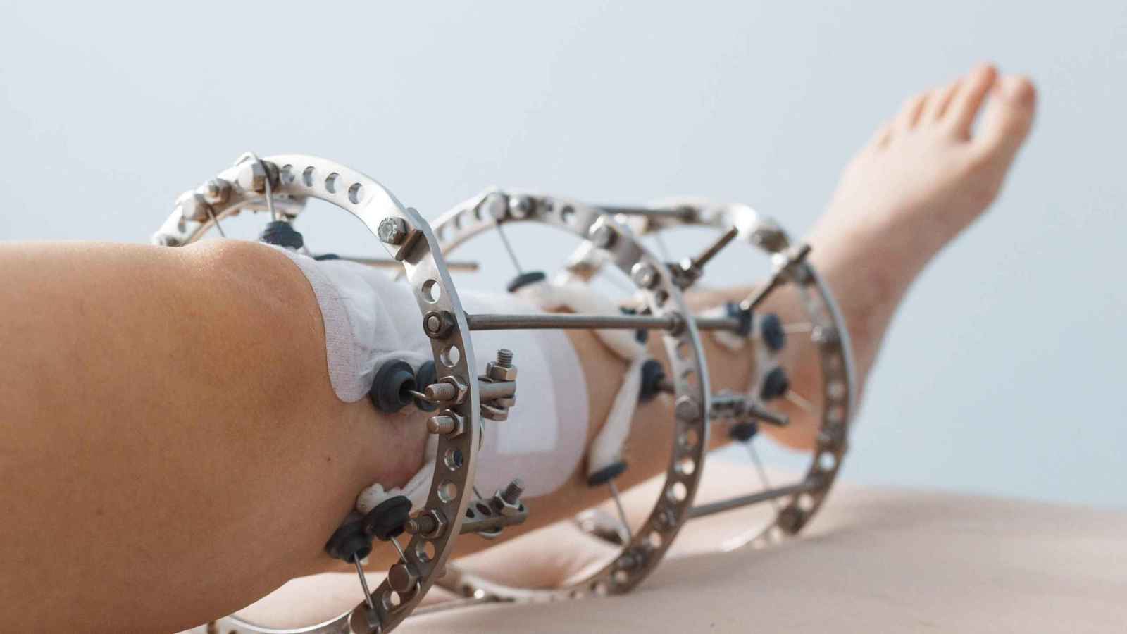 كيف تحولت جراحة إطالة الساق إلى موضة تجميلية؟